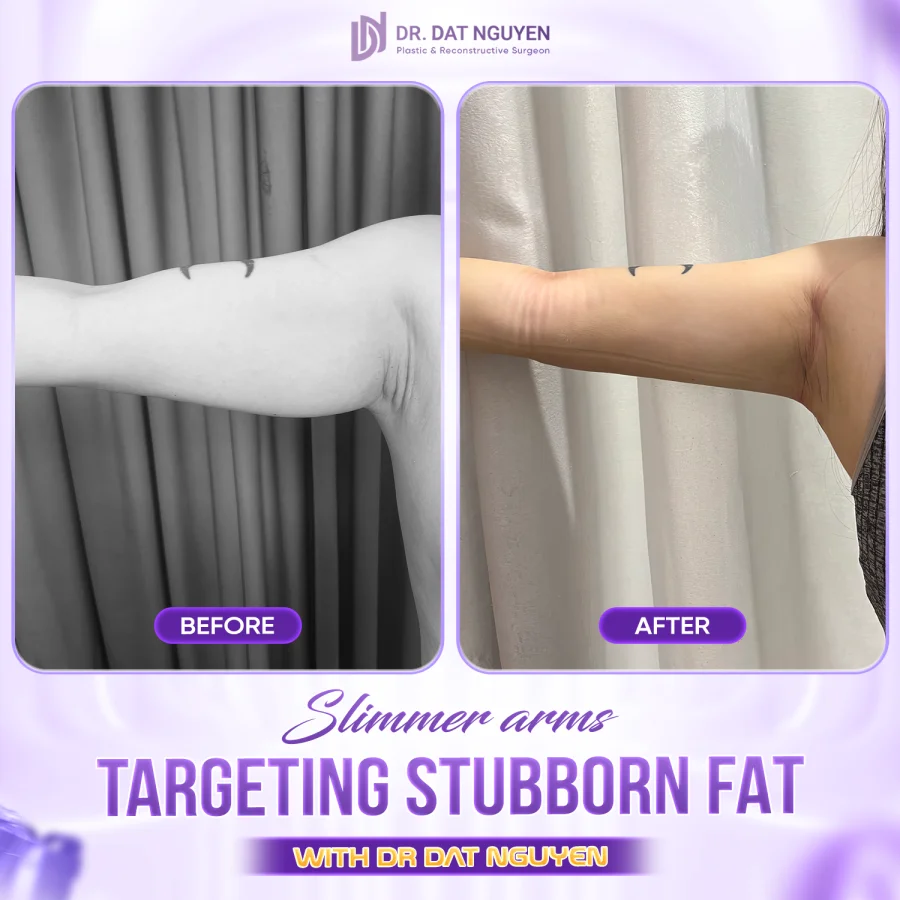 Arm liposuction before and after