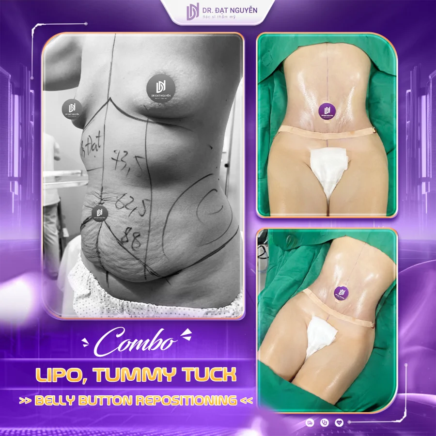 Liposuction with tummy tuck and belly-button repositioning before and after