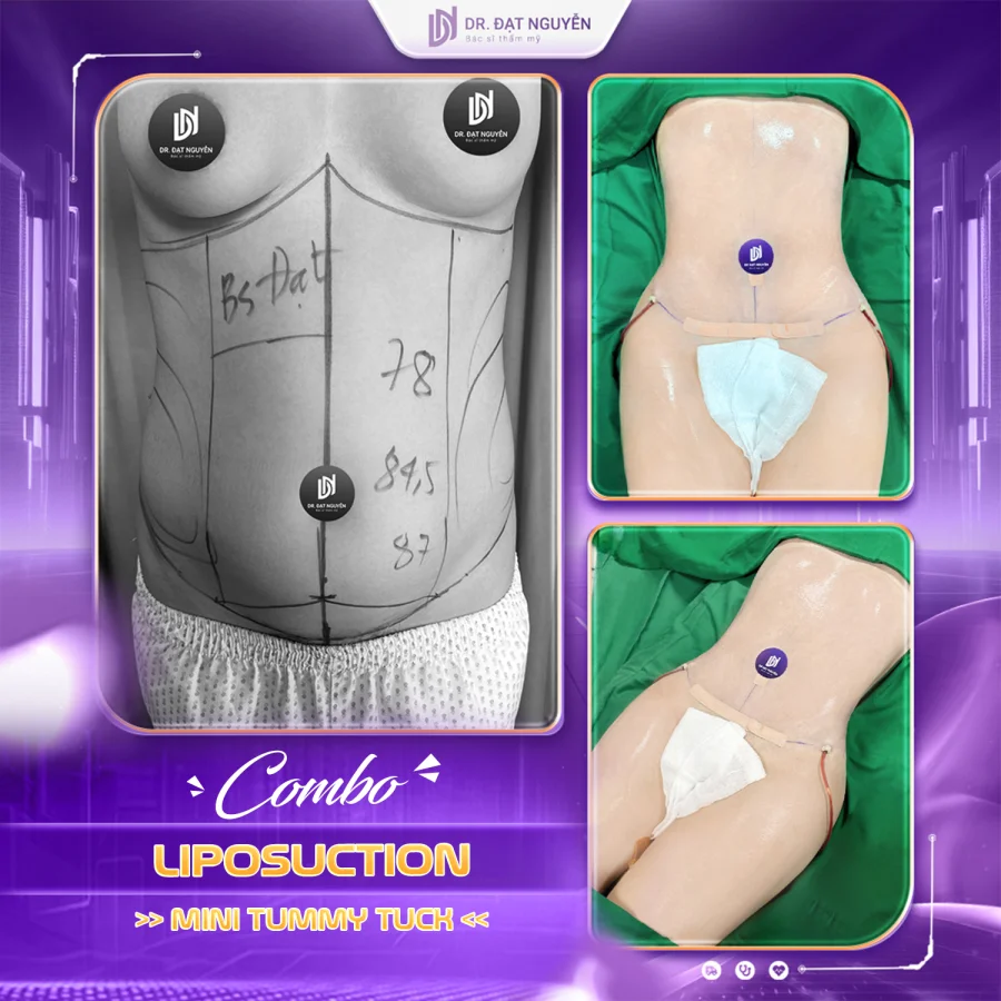 Liposuction with mini tummy tuck before and after