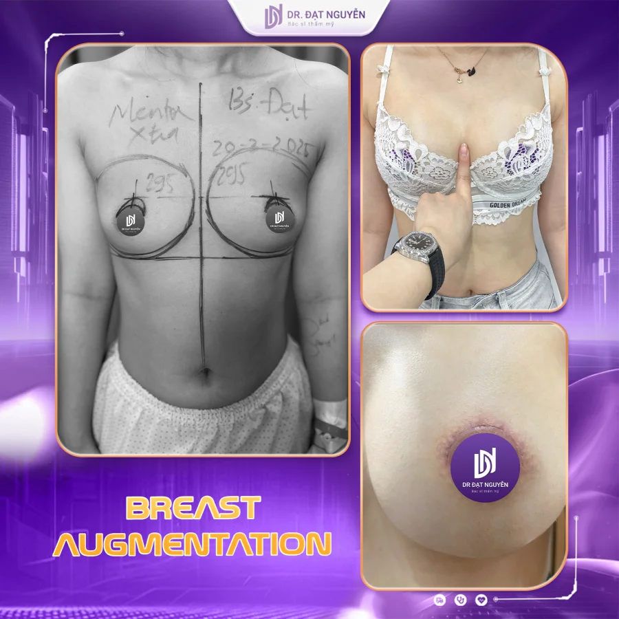 Breast augmentation before and after
