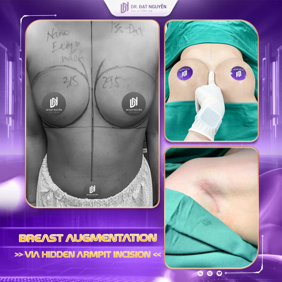 Breast augmentation via hidden armpit incision before and after