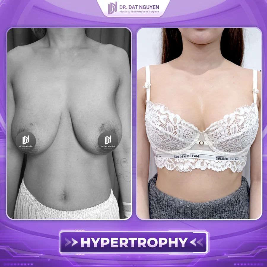 Breast reduction for hypertrophy before and after