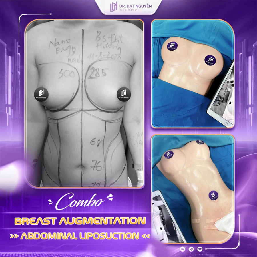 Breast augmentation with abdominal liposuction before and after
