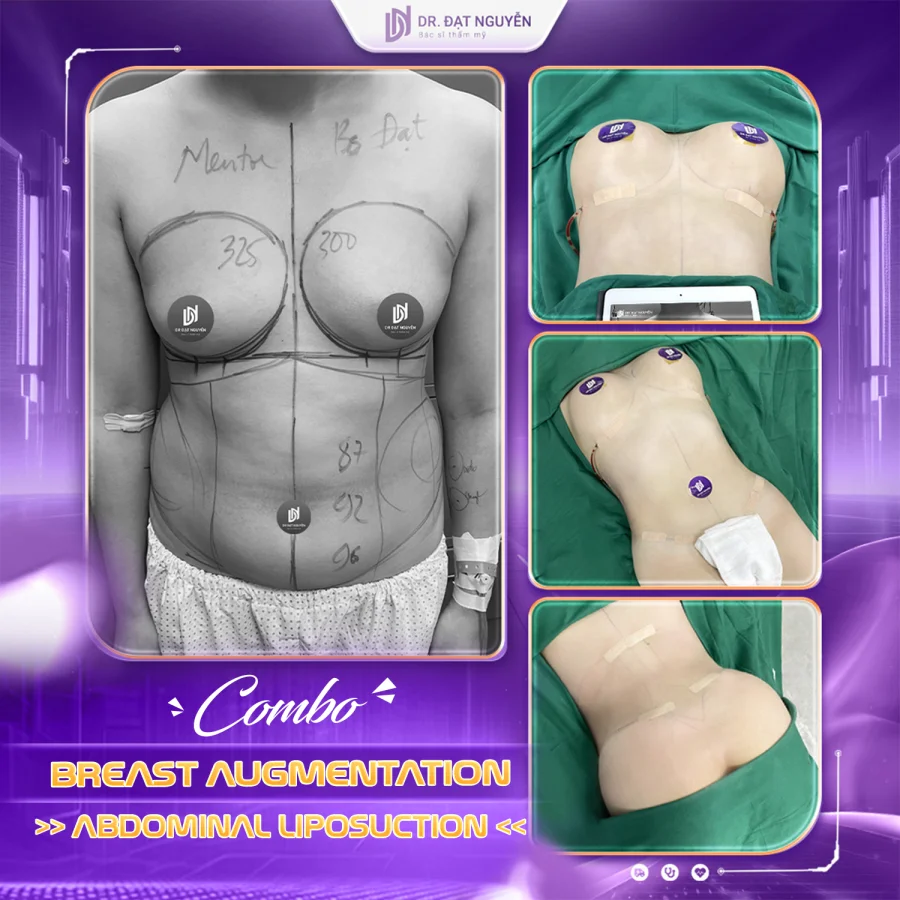 Breast augmentation with abdominal liposuction before and after