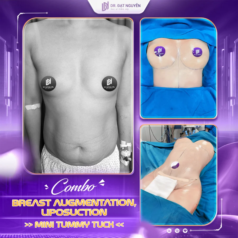 Breast augmentation, liposuction and mini tummy tuck before and after