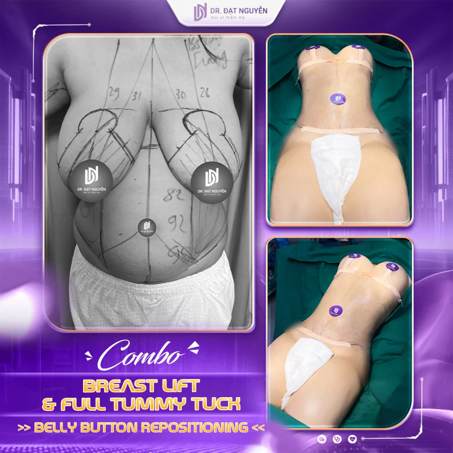 Breast lift with full tummy tuck before and after