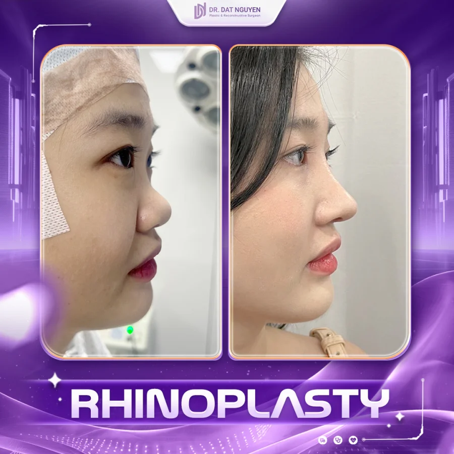 Rhinoplasty before and after