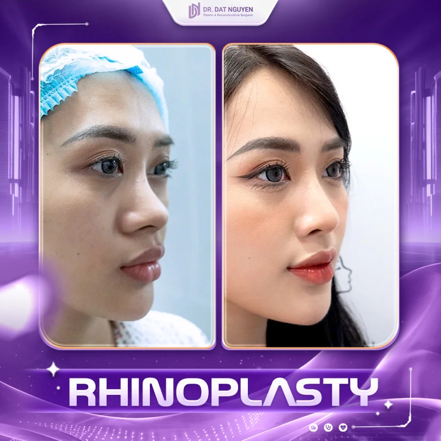 Rhinoplasty before and after