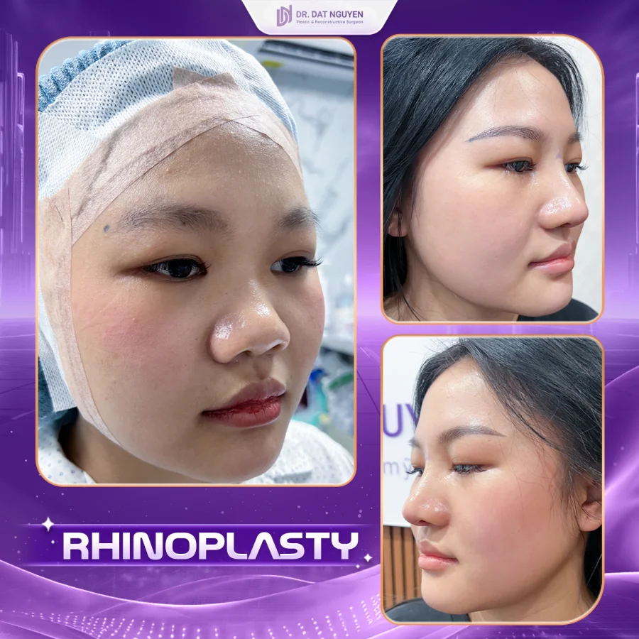 Rhinoplasty before and after